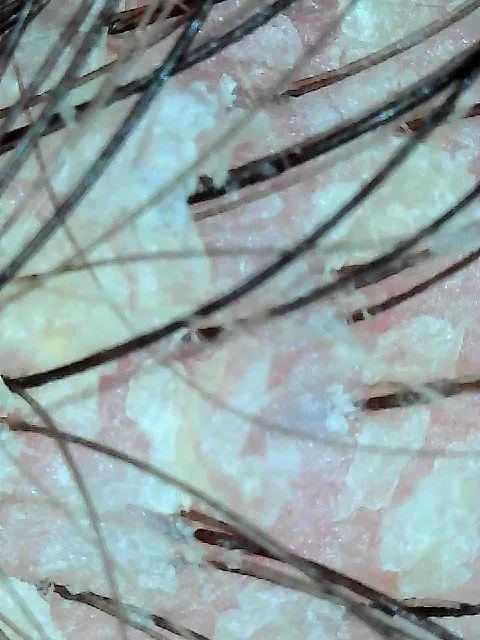 Real scalp before head spa treatment showing dry flaking and follicle buildup, The Beauty of Zen Worcester MA